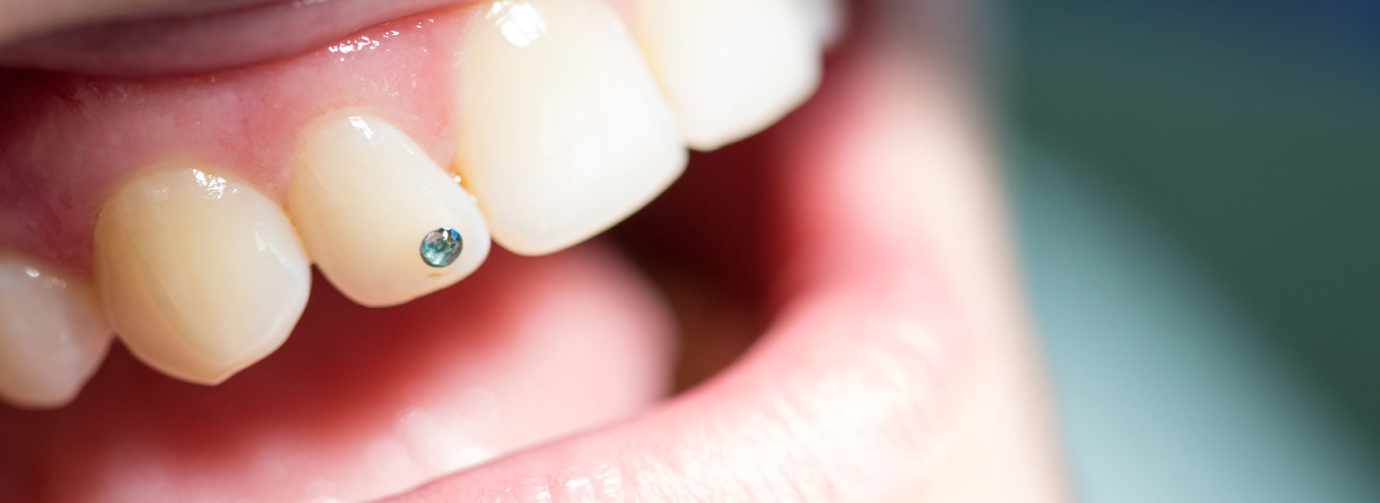 Nahaufnahme eines Mundes mit qualitativ hochwertigen und natürlich wirkenden Zahnersatz durch die Zahnarztpraxis Zahnärzte im Wengentor in Ulm