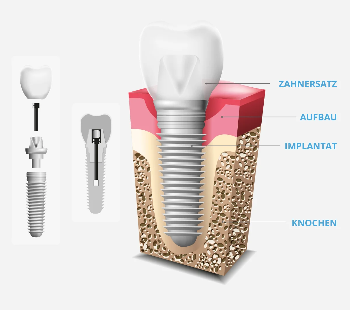 Zahnimplantat-Aufbau mit Implantat, Knochen und Zahnersatz (ZahnÀrzte Ulm)